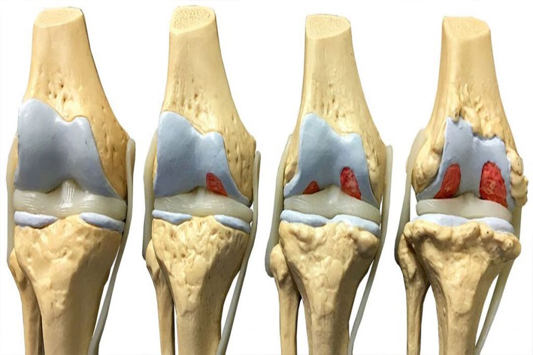 Stadien der Entwicklung einer Arthrose