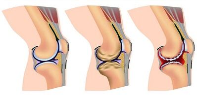 Entwicklungsphase der Arthrose des Kniegelenks