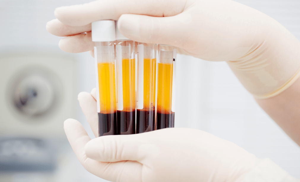 Plättchenreiches Plasma zur PRP-Therapie bei Arthrose